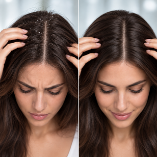 Prodotti Antiforfora Capelli